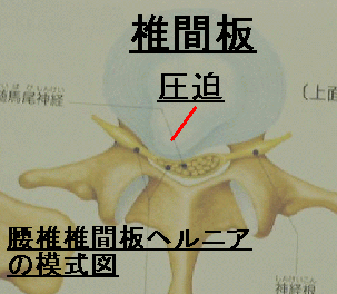 hernia2